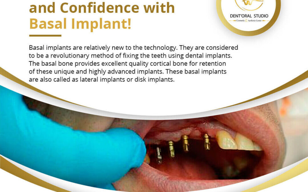 Best Dental Implant Treatment In Lahore DentOral Studio