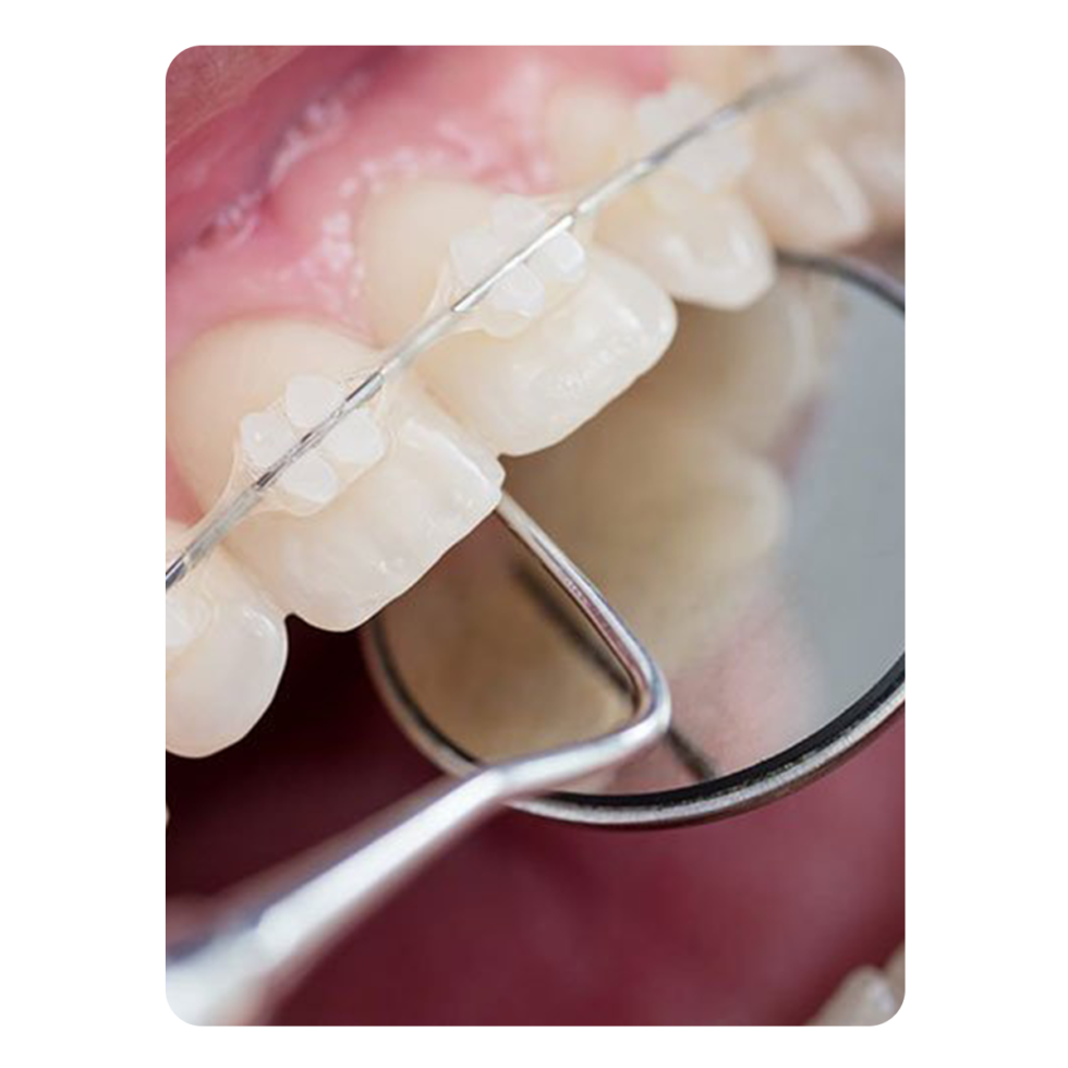The Best Braces Invisalign In Lahore Dentoral Studio