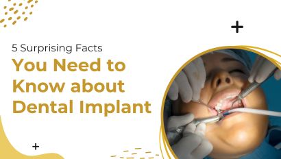 5 Surprising Facts You Need to Know about Dental Implant