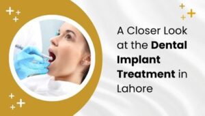 A Closer Look at the Dental Implant Treatment in Lahore