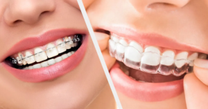 Braces vs Invisalign