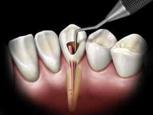 Root Canal Treatment