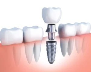 Dental Implants Solutions