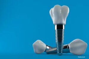 Dental Implants in Lahore
