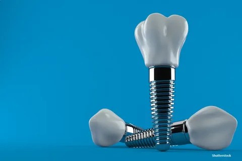 Dental Implants in Lahore