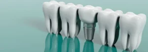Dental Implants