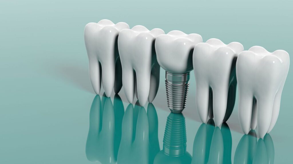 Dental Implants