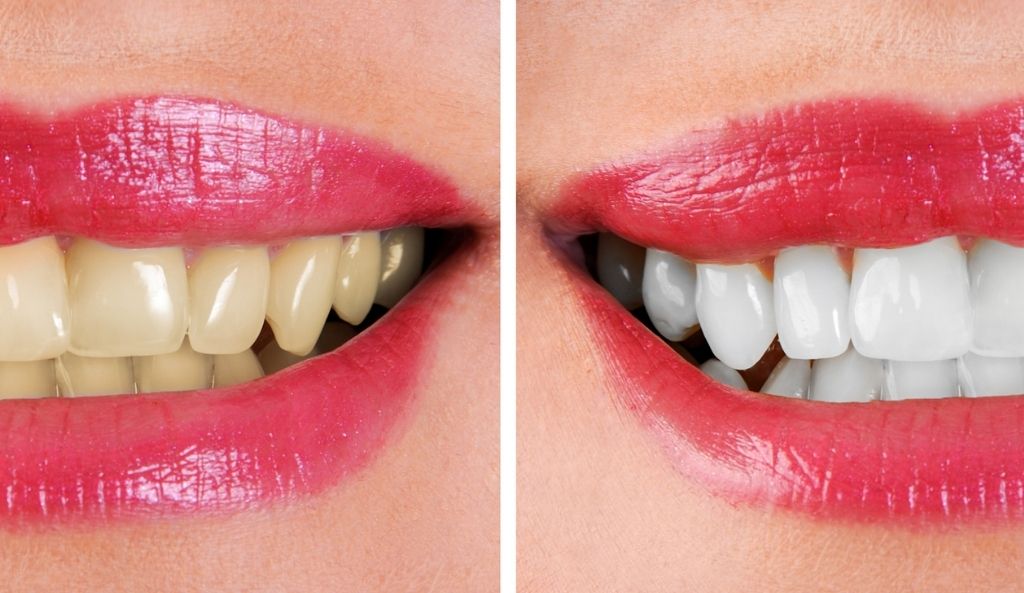 Teeth Whitening Techniques