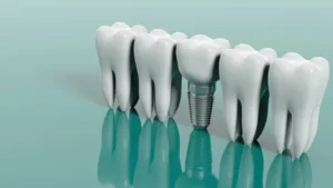 Dental Implants in Lahore