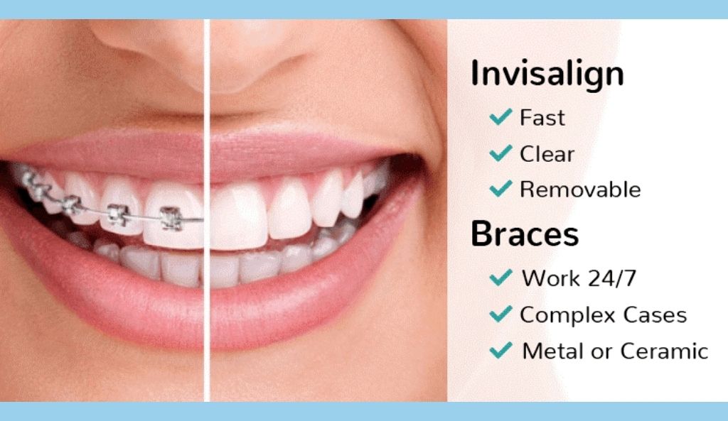  Braces and Invisalign 