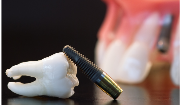 Wisdom Tooth Impaction: Symptoms, Treatment, and Expert Care - Dentoral