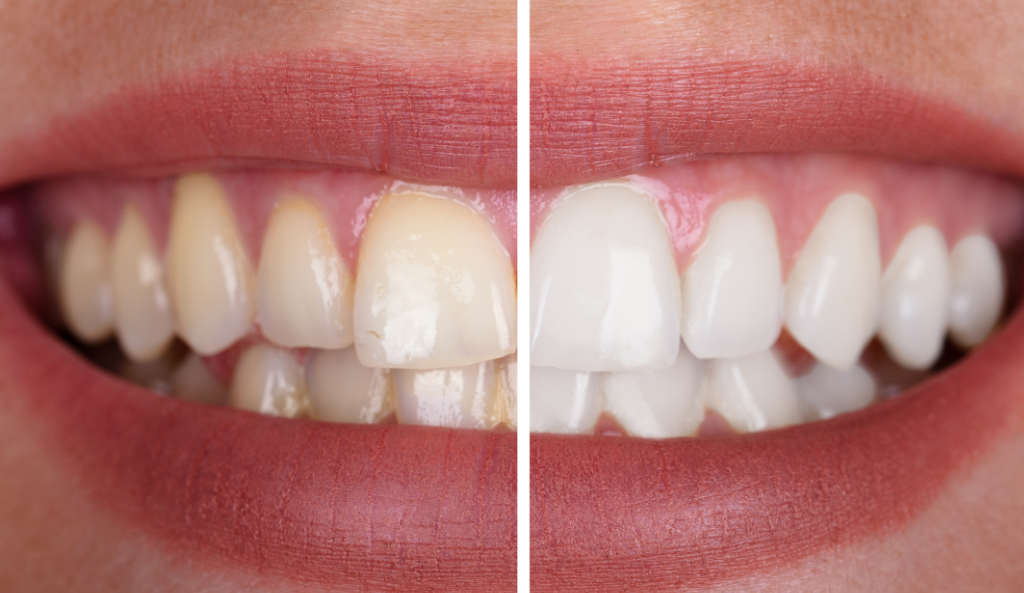 Professional Teeth Whitening Treatments