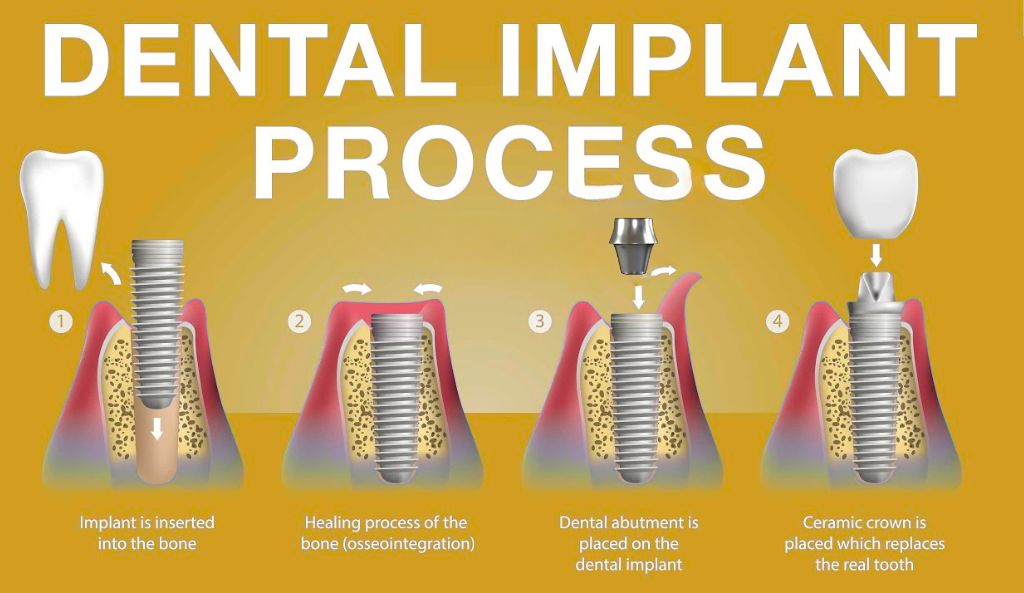 Eligible For Dental Implants in Lahore 2025