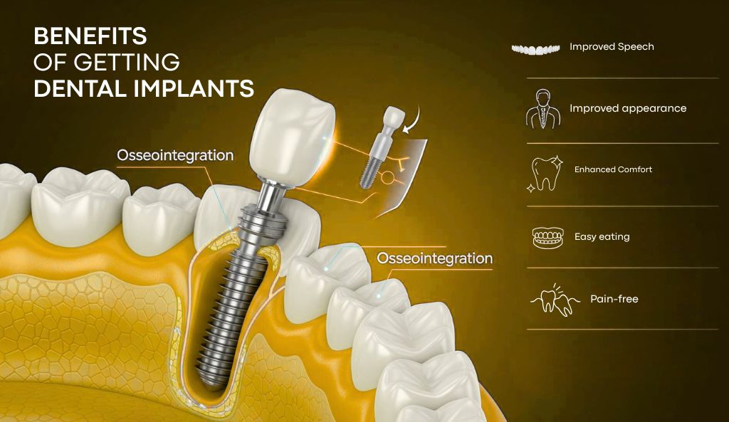 What Are The Benefits Of Getting Dental Implants?