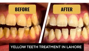 Yellow Teeth Treatment in Lahore