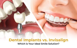 Dental Implants vs. Invisalign