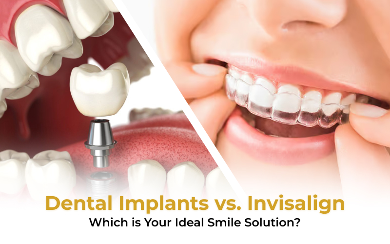 Dental Implants vs. Invisalign