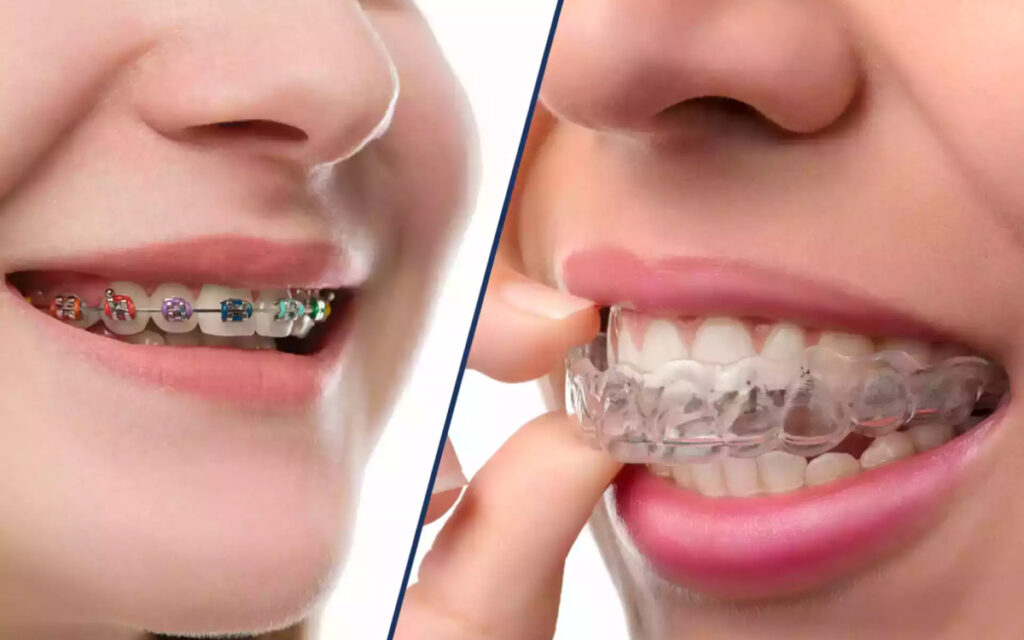 Braces vs Invisalign_ Which is