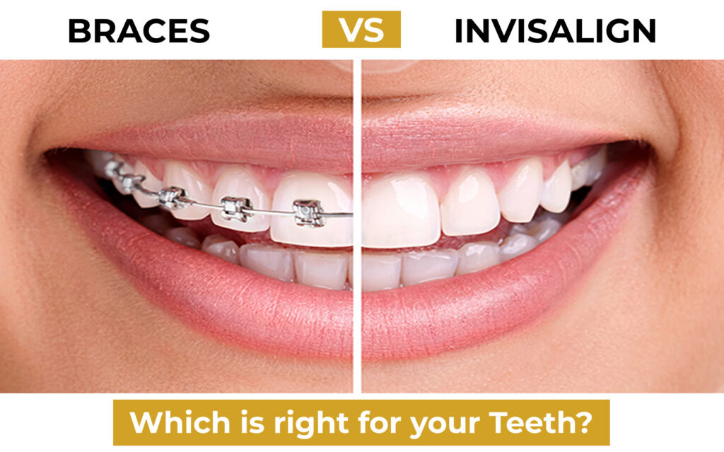 Braces vs Invisalign_ Which is Right for Your Teeth_ (2)