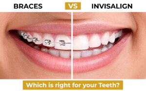 Braces vs Invisalign_ Which is Right for Your Teeth_ (2)