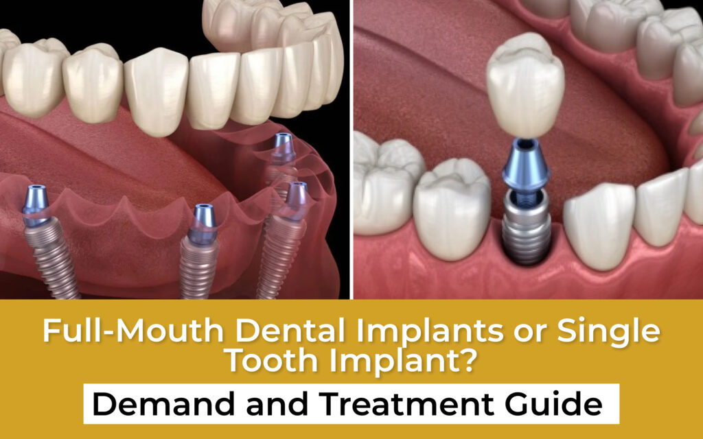 Single Tooth Implant or Full Mouth Dental Implants? Demand & Treatment Guide