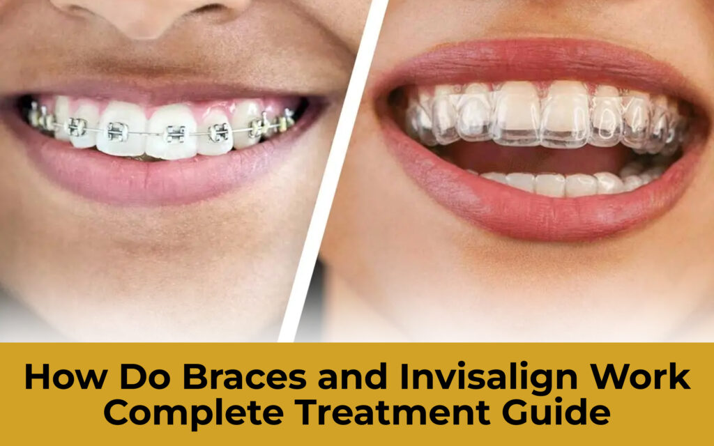 How Do Braces and Invisalign Work? - Your Complete Treatment Guide