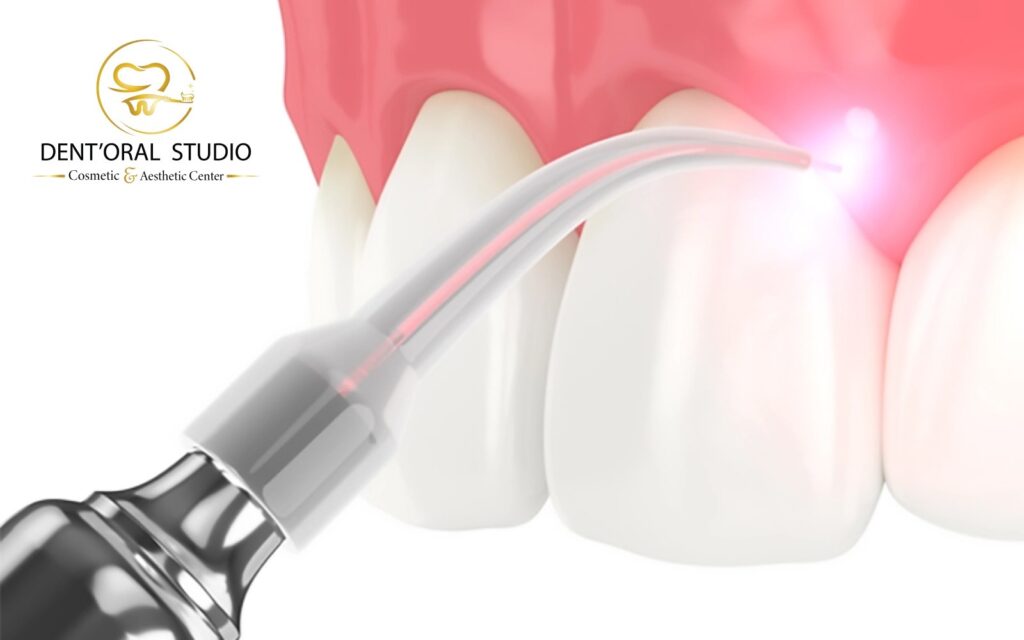 No Drills, No Stress: How Painless Laser Fillings are Redefining Dentistry in 2026?