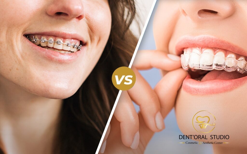 The 2026 Orthodontic War in Lahore_ Is Invisalign Actually Better Than Metal Braces_ (1)