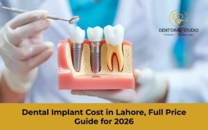 Dental Implants Cost in Lahore 2026 | A Complete Guide